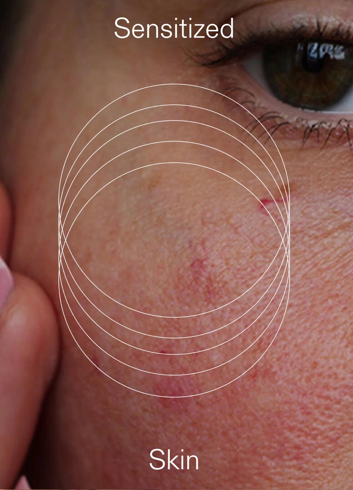 Close-up of sensitive skin showing redness and uneven texture, with text overlay labeling it as "Sensitized Skin."