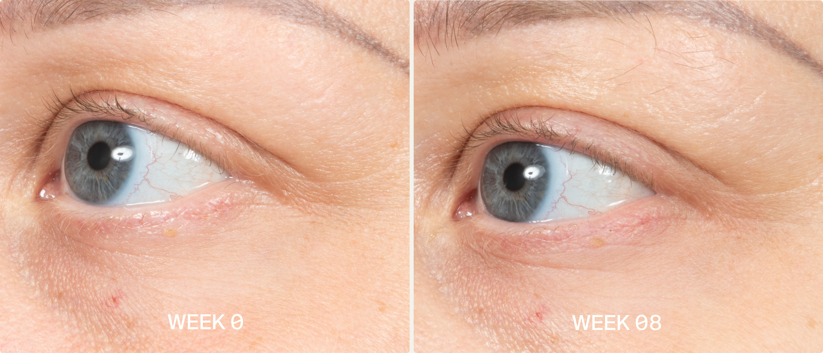 wrinkles before and after