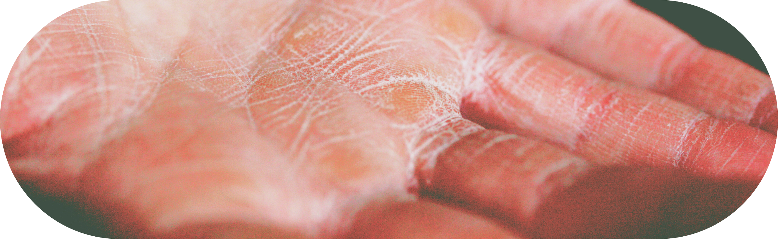 Dry Skin close up