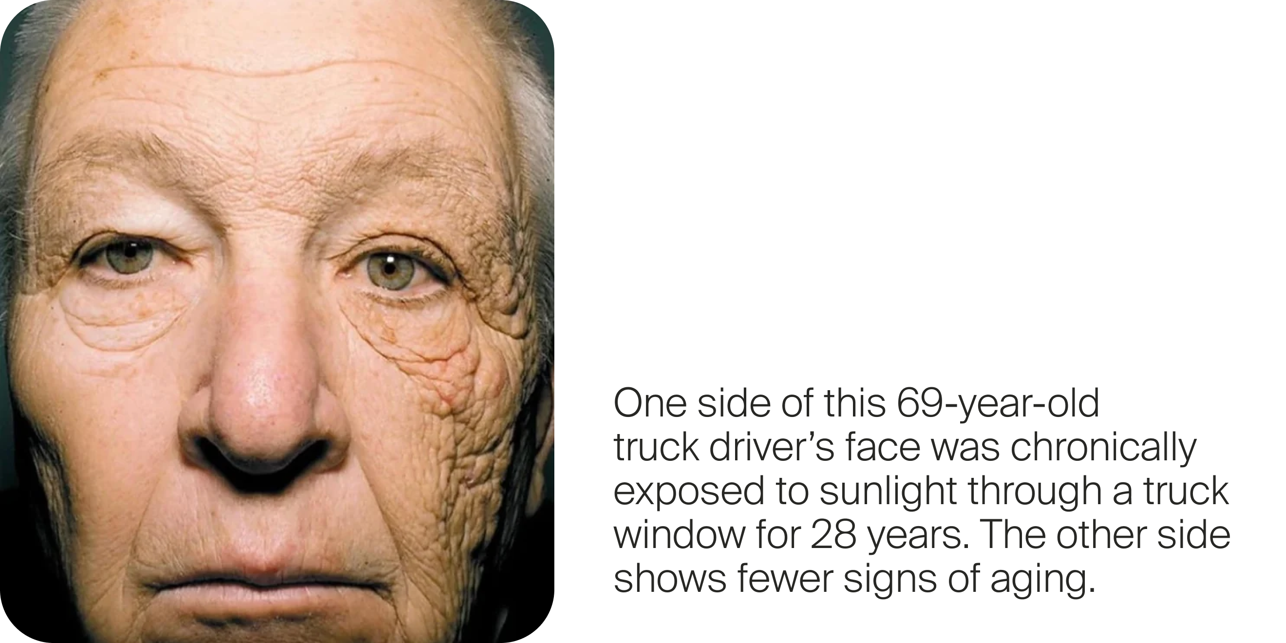 One side of this 69-year-old truck driver’s face was chronically exposed to sunlight through a truck window for 28 years. The other side shows fewer signs of aging.