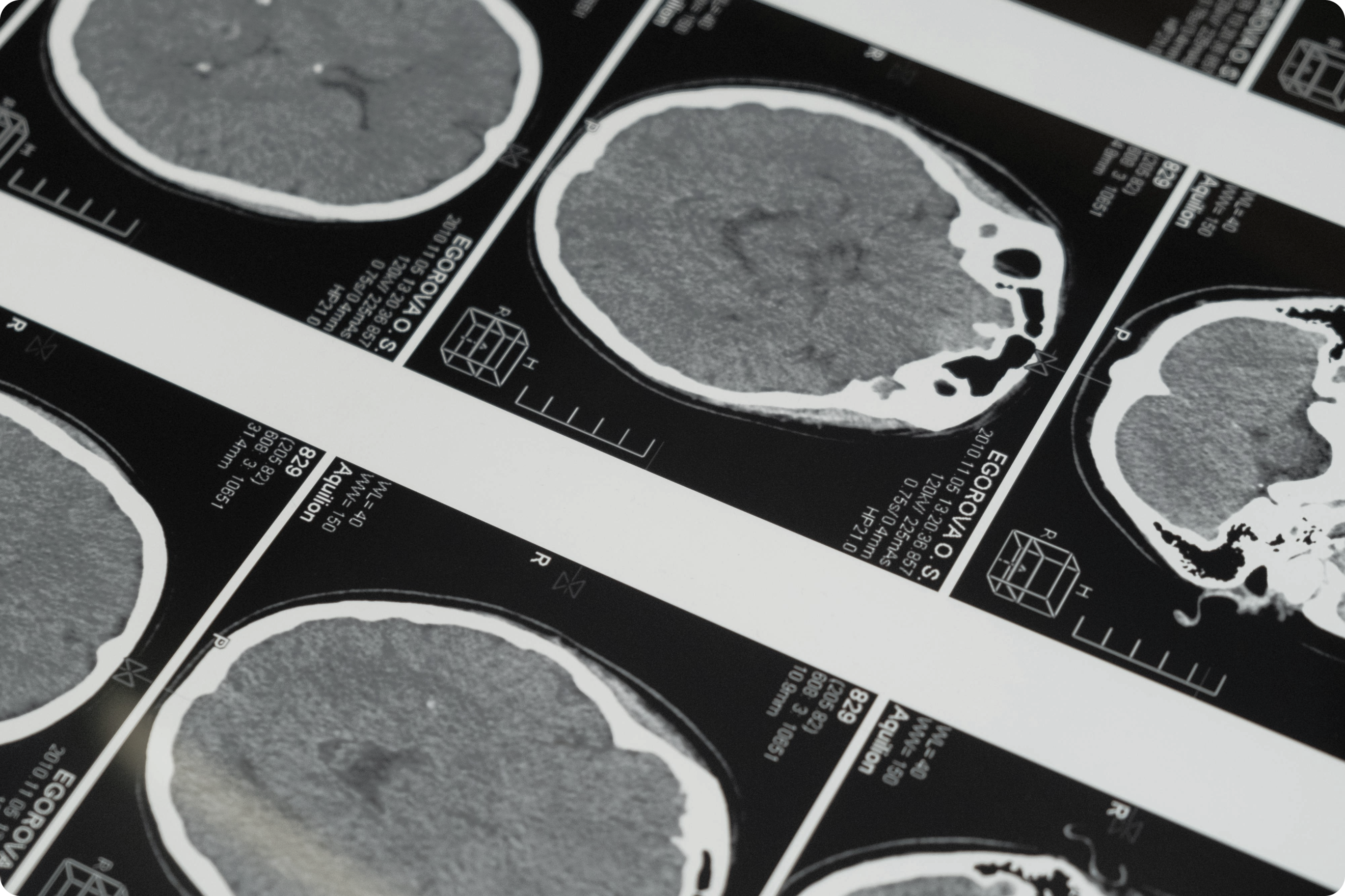 Brain scan