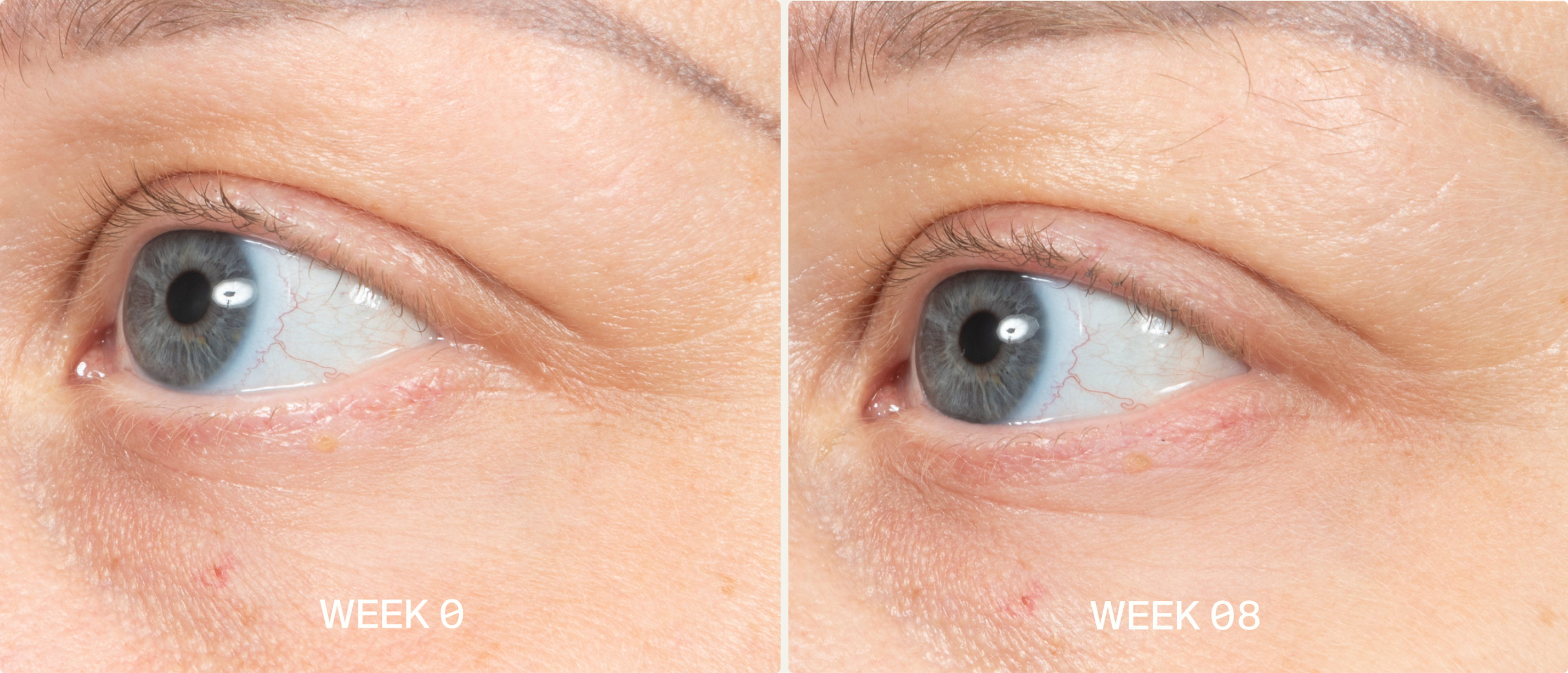 wrinkles before and after