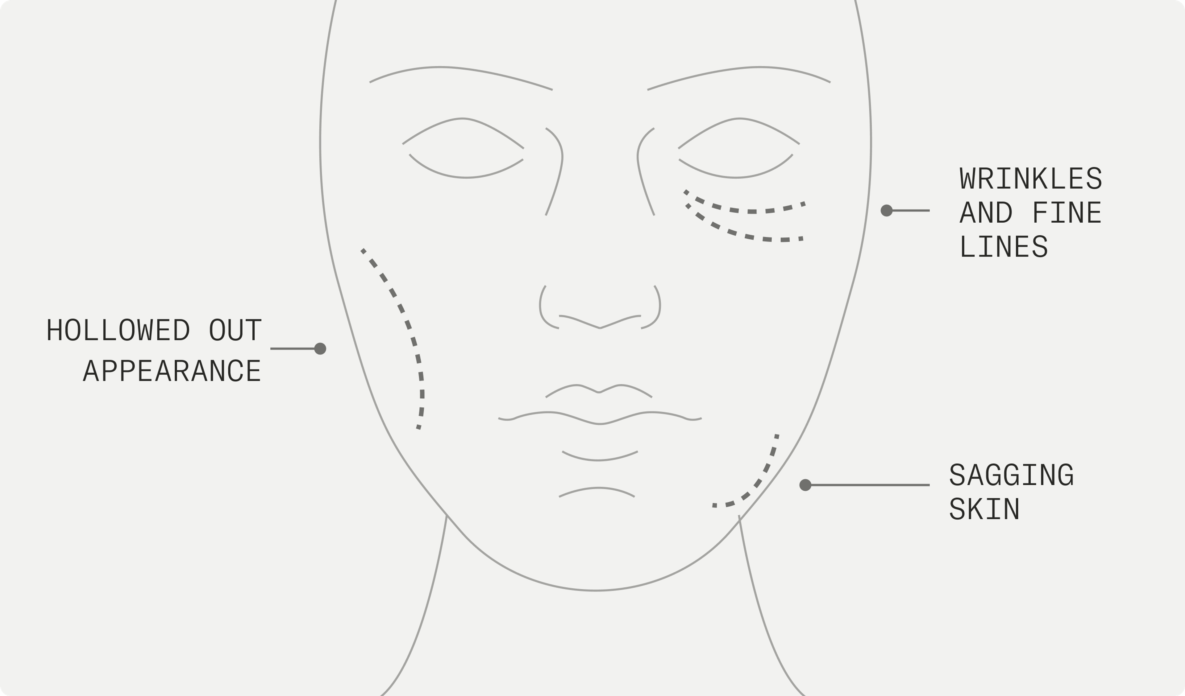 Some signs of the Ozempic Face