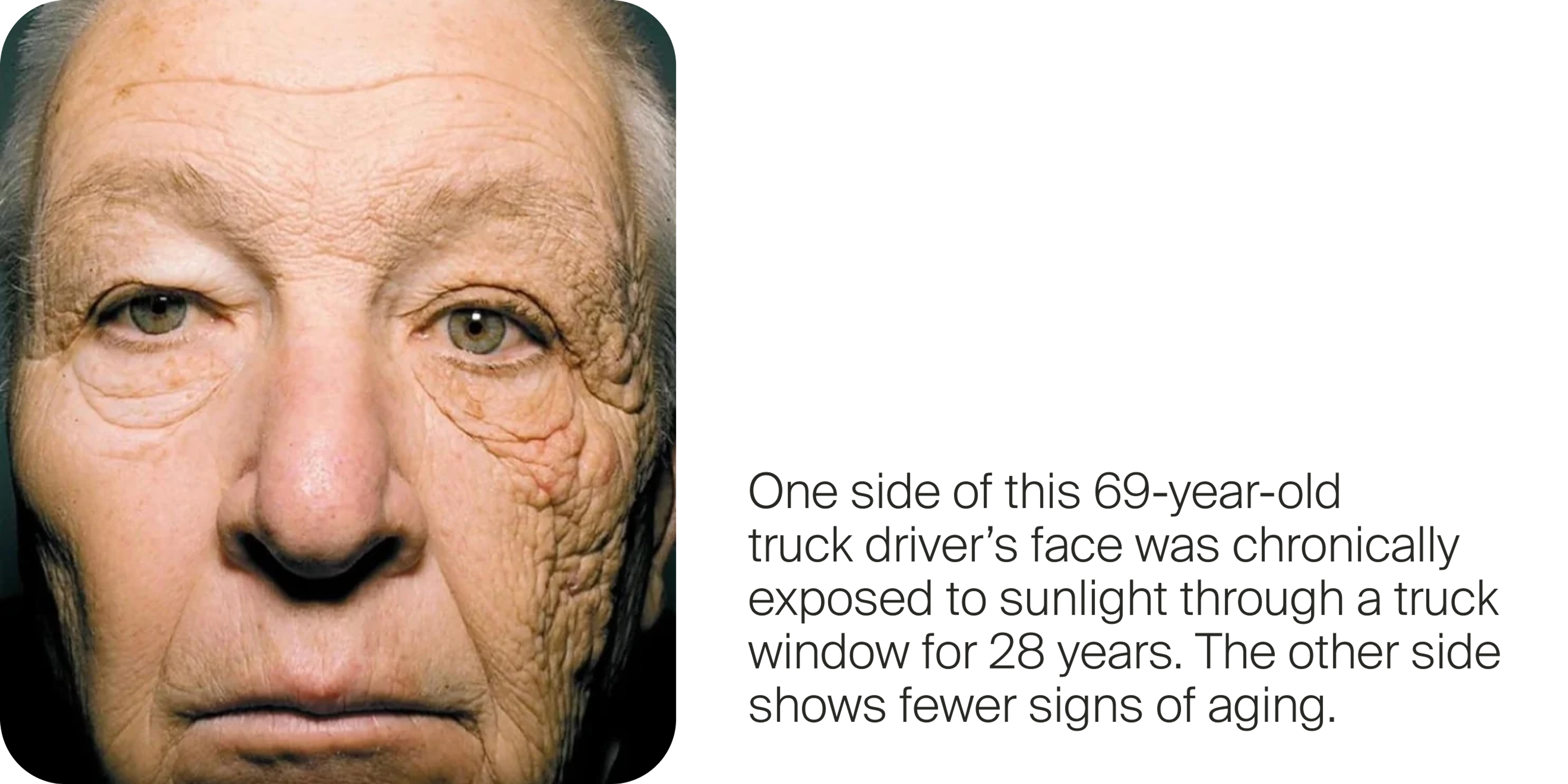 One side of this 69-year-old truck driver’s face was chronically exposed to sunlight through a truck window for 28 years. The other side shows fewer signs of aging.