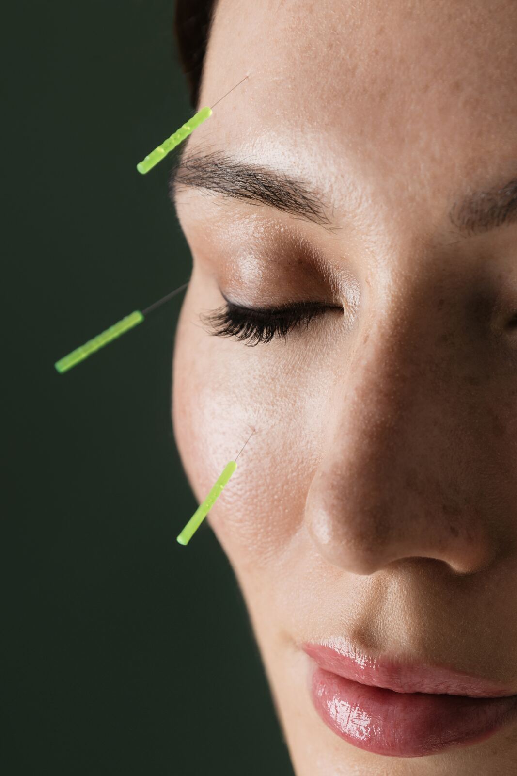 Acupuncture needles placed along a patient's cheek and brow