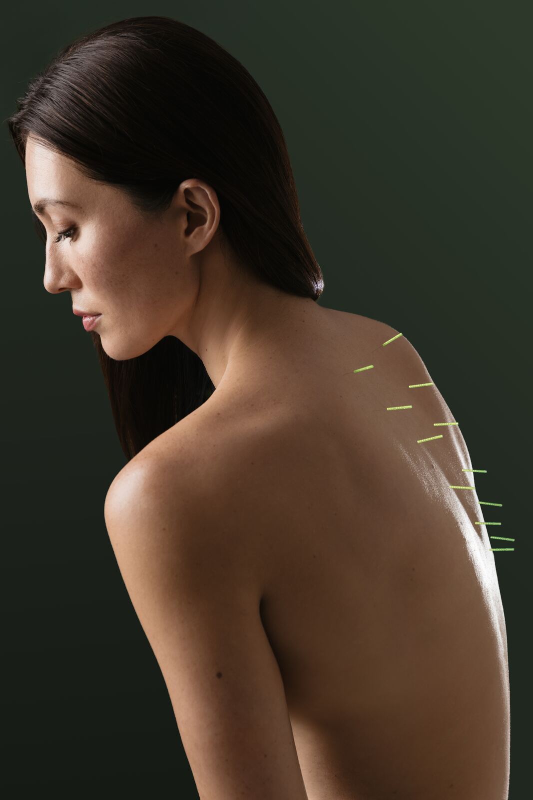 Acupuncture needles along a patient's shoulder and spine