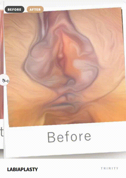 소음순수술의 기준: 강남 트리니티여성의원의 '절대적 정밀함'