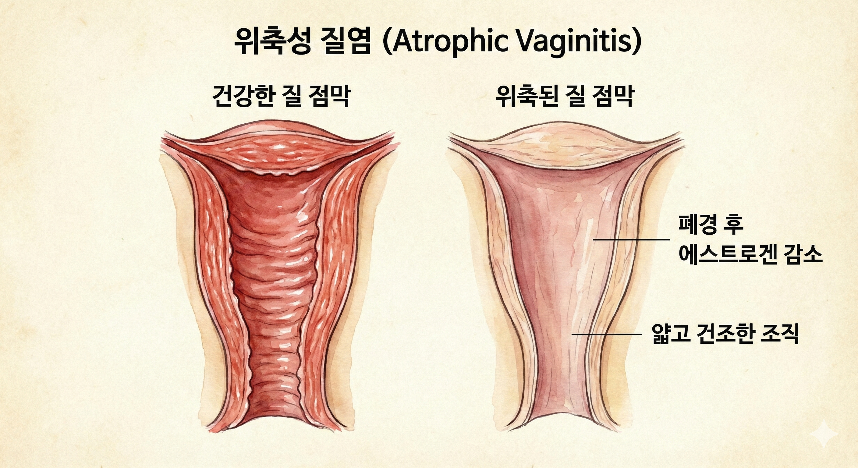 질레이저 꼭 해야하는 사람은? 효과, 종류별 비교, 가격