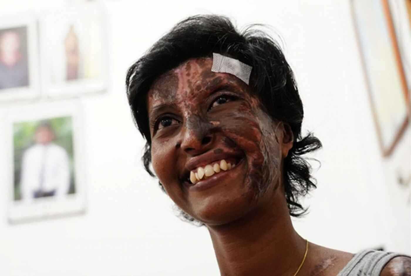‘Christ made us priceless treasures’—Sri Lankan bomb survivor’s face glows with joy