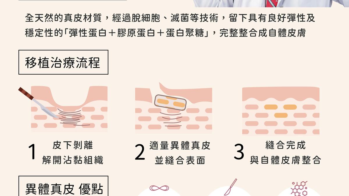 異體真皮 (ADM) 如何免開第二刀實現永久性痘疤填補？深度解析 ADM 的材料特性、手術方式與長期效果。