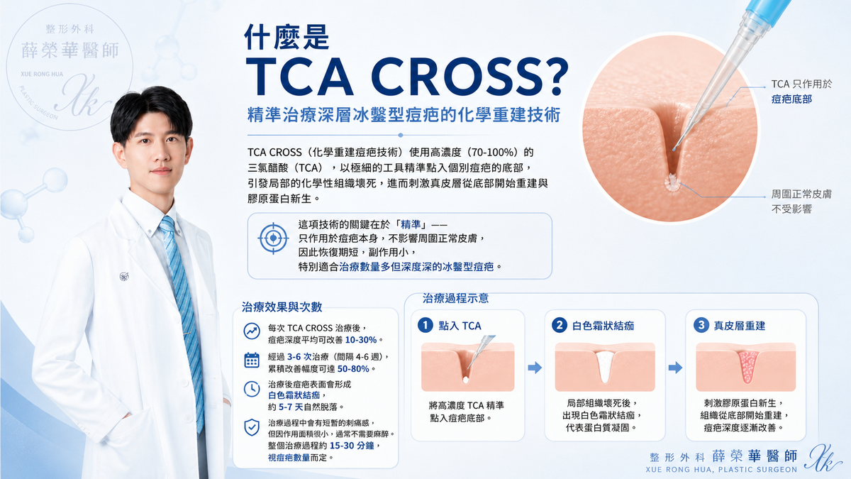 以高濃度三氯醋酸精準點入個別痘疤內，刺激真皮層組織重建與膠原蛋白新生，特別適合冰鑿型痘疤。
