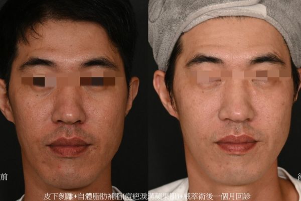 全臉滾動型痘疤治療01