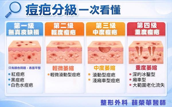 痘疤分級一次看懂｜你的痘疤屬於哪一型