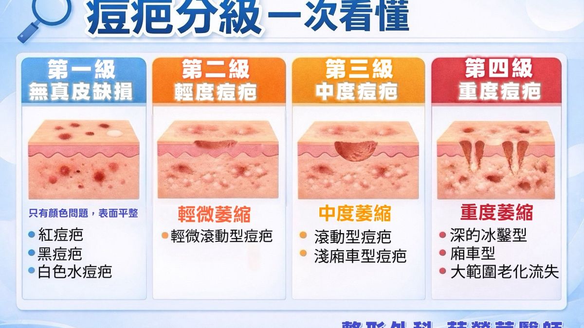 痘疤分級一次看懂｜你的痘疤屬於哪一型