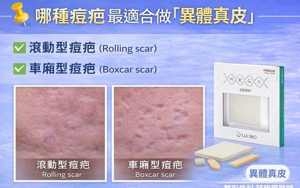 異體真皮 (MegaDerm) 深度解析：一種免開第二刀的永久性填補選擇。