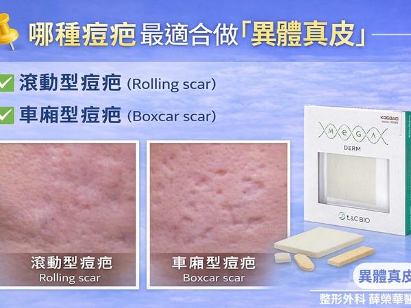 異體真皮移植 ADM Grafting
