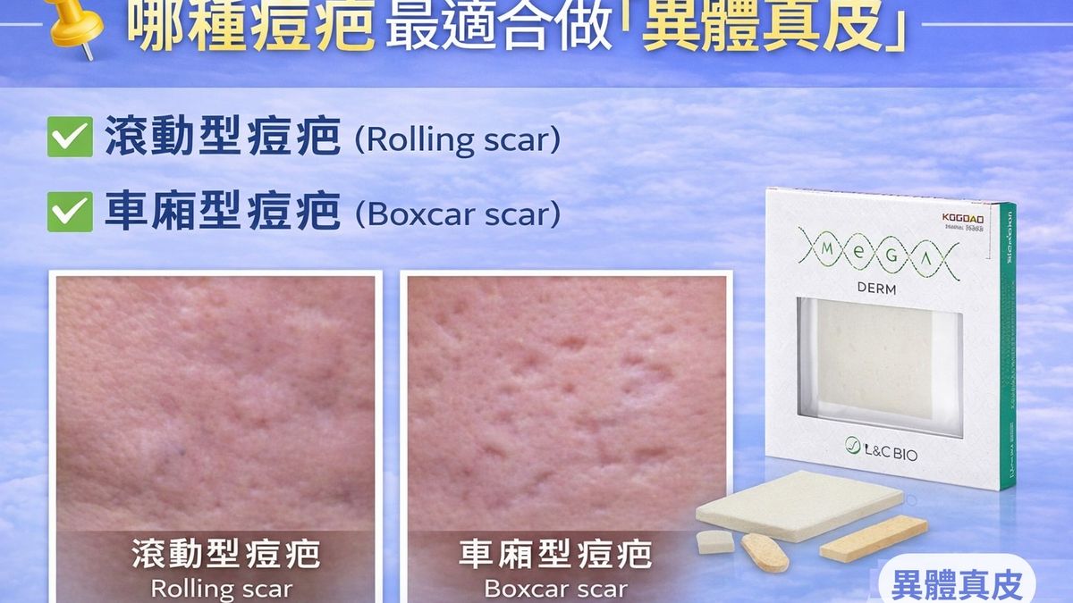 異體真皮可切割適當大小後放置於痘疤底層。