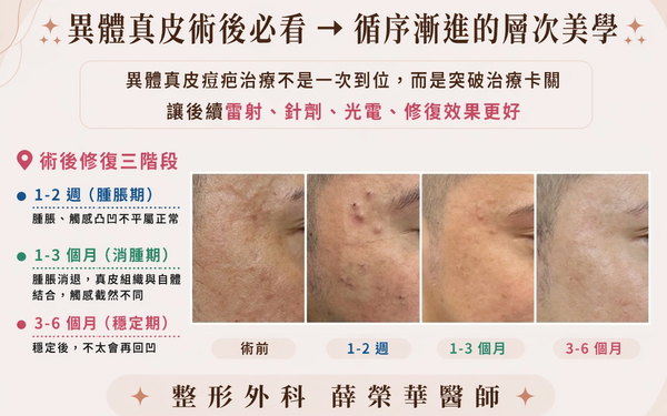 異體真皮術後必看 ➝ 循序漸進的層次美學