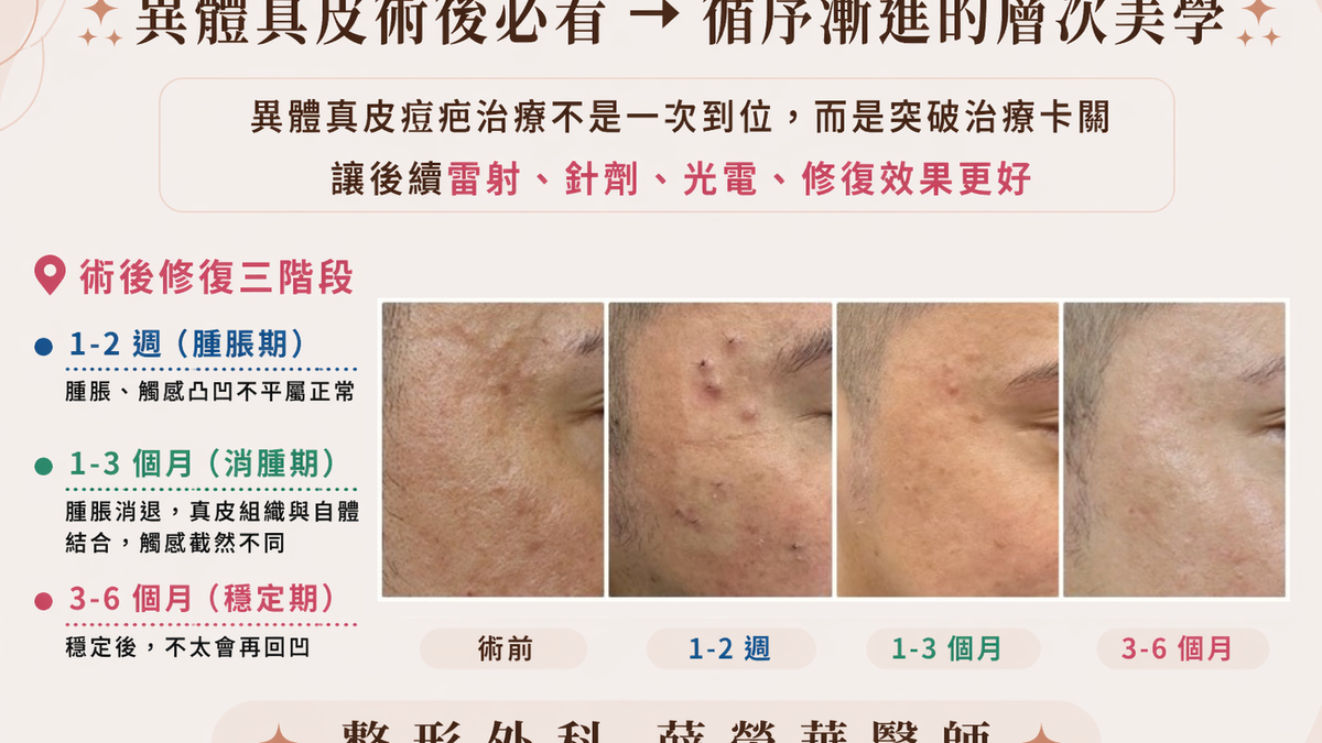 做完異體真皮手術後，客人最常問的問題  Q：什麼時候見效？修復期多久？  異體真皮術後修復三階段 • 1-2 週（腫脹期）：腫脹、觸感凹凸不平屬正常 • 1-3 個月（消腫期）：腫脹消退，真皮組織與自體結合，觸感截然不同 • 3-6 個月（穩定期）：穩定後，不太會再回凹