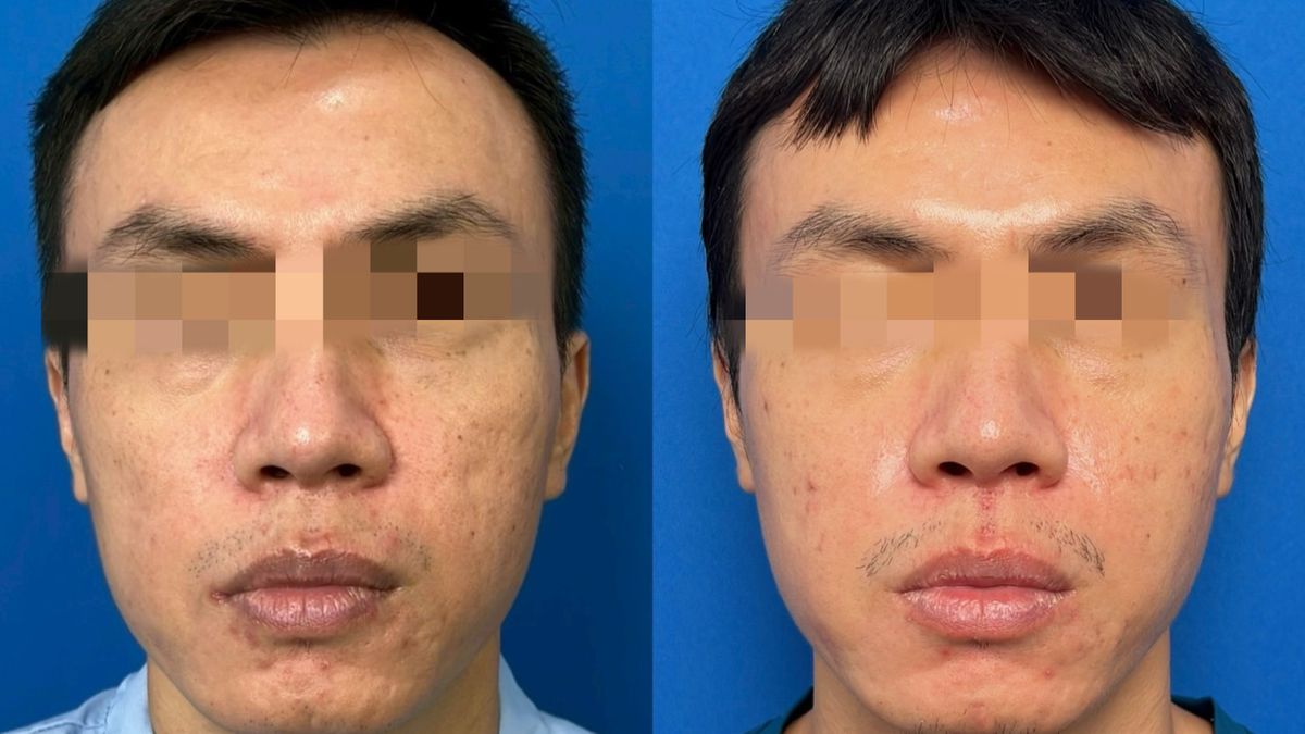 正面治療比對圖片