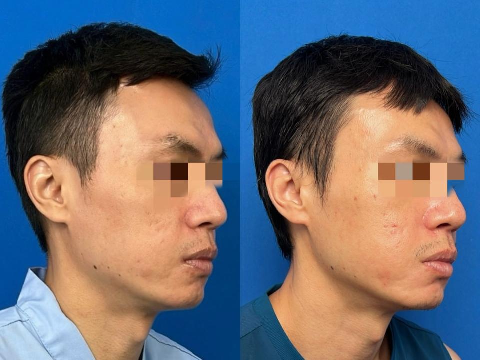 右側45度治療後照片比對經一個月後改善良好