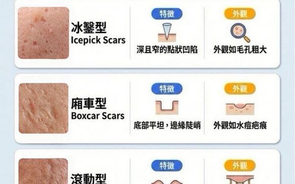 別讓「月球表面」跟著你：醫師詳解凹陷型痘疤的三大類型（冰鑿、廂車、滾動）