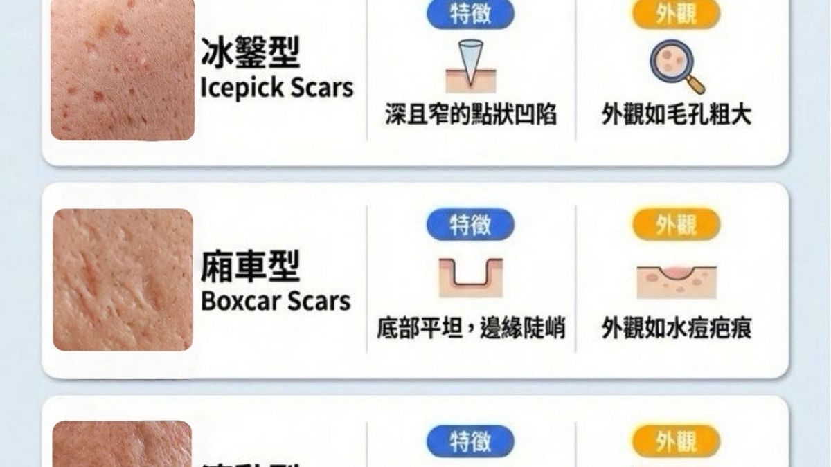 超過 70% 的痘疤病患屬於「複合型」。這也是為什麼單一的雷射療程往往無法讓病患滿意。在我的診間，我會為病患進行詳細的「疤痕地圖評估」，針對滚動型做剝離、針對深層廂車型做真皮移植、針對冰鑿型做複合式治療。