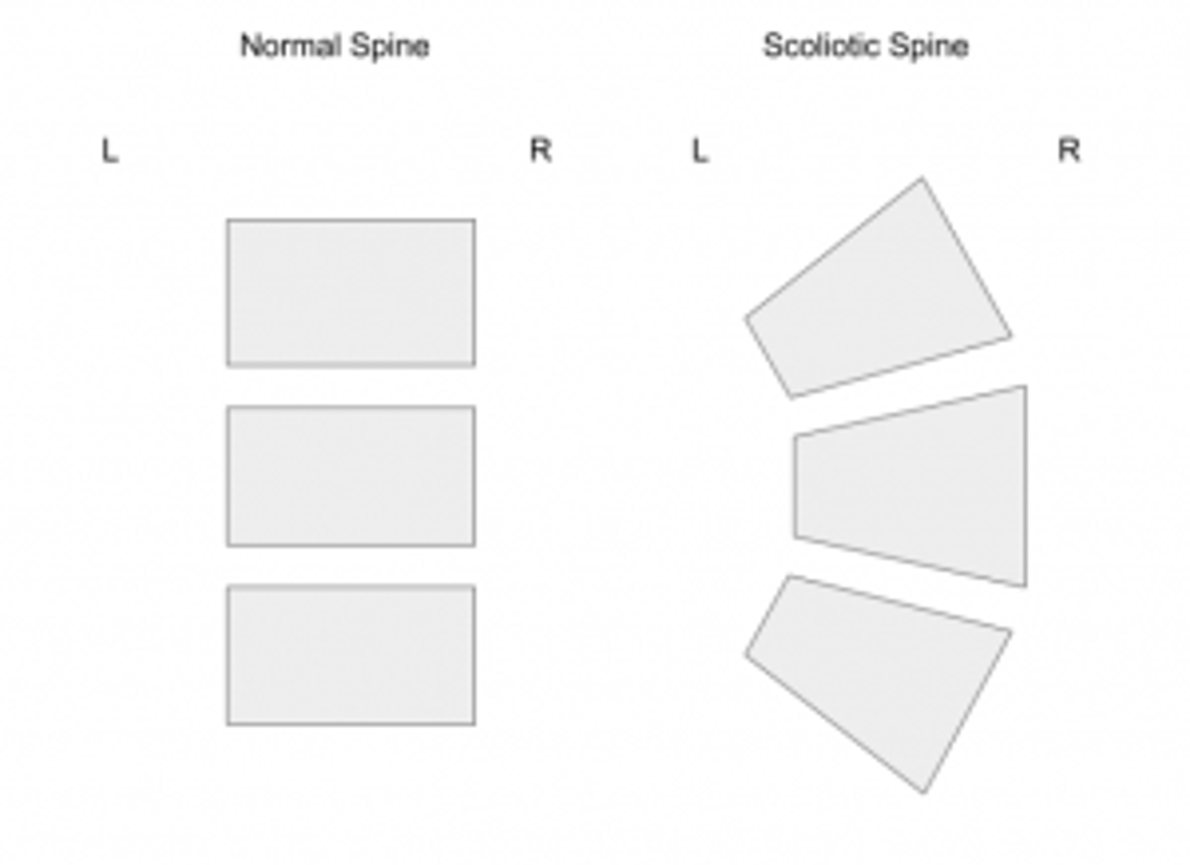 Diagram comparing a normal spine, with level rectangular vertebrae, to a scoliotic spine, with tilted wedge-shaped vertebrae