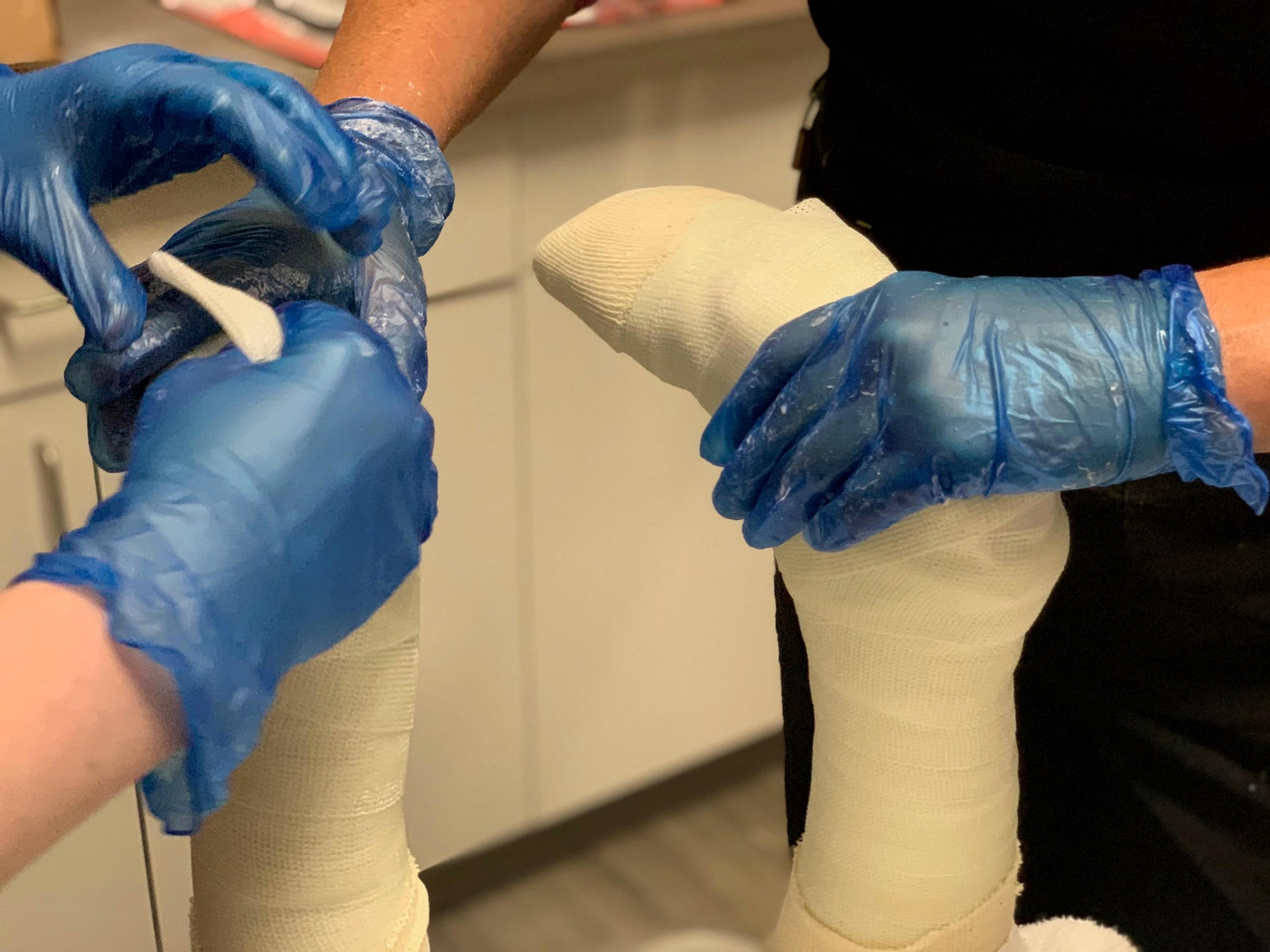 Close-up of gloved hands smoothing a white cast around a child's foot and lower leg