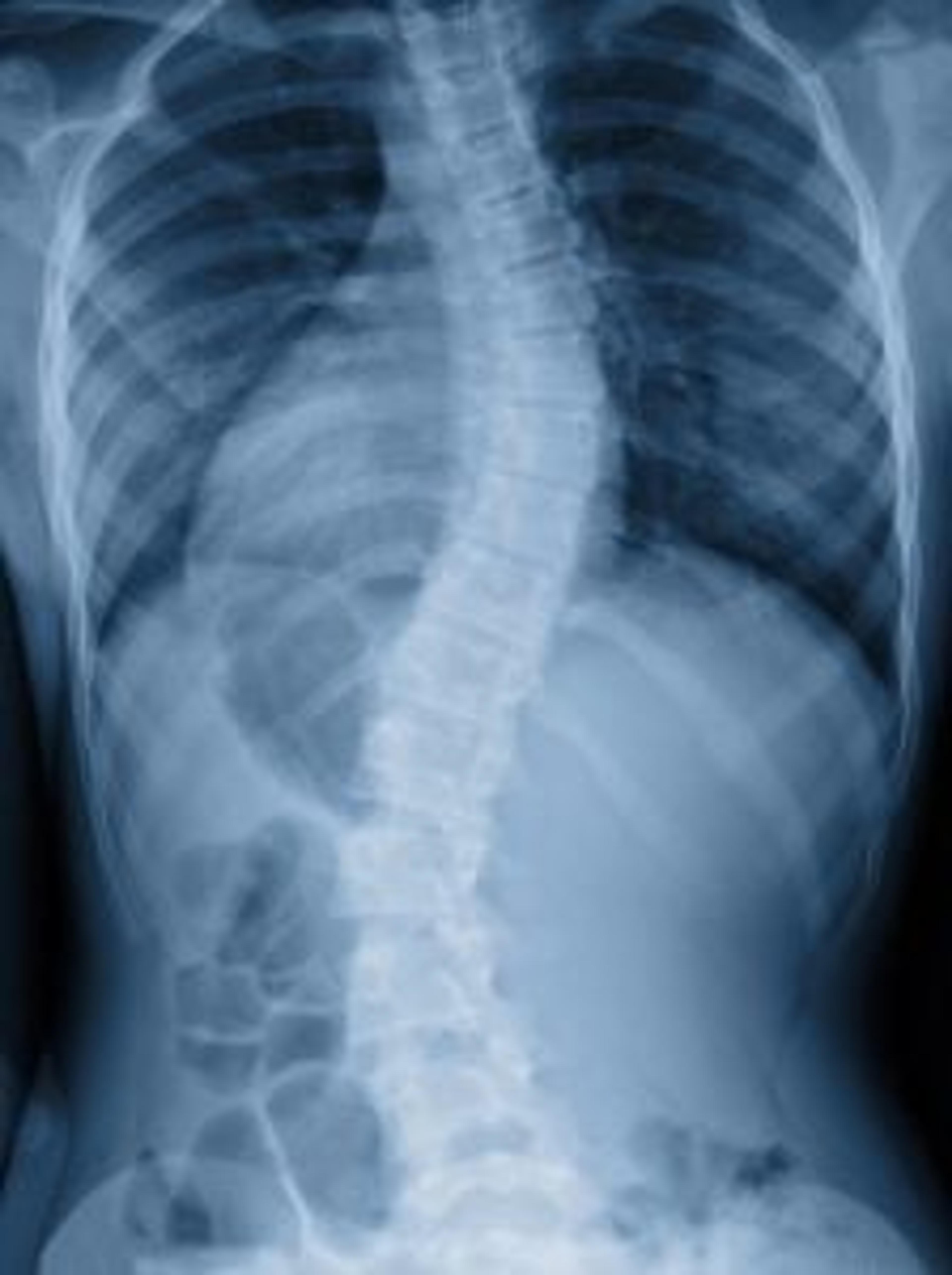 X-ray of a torso showing a spine that curves from side to side