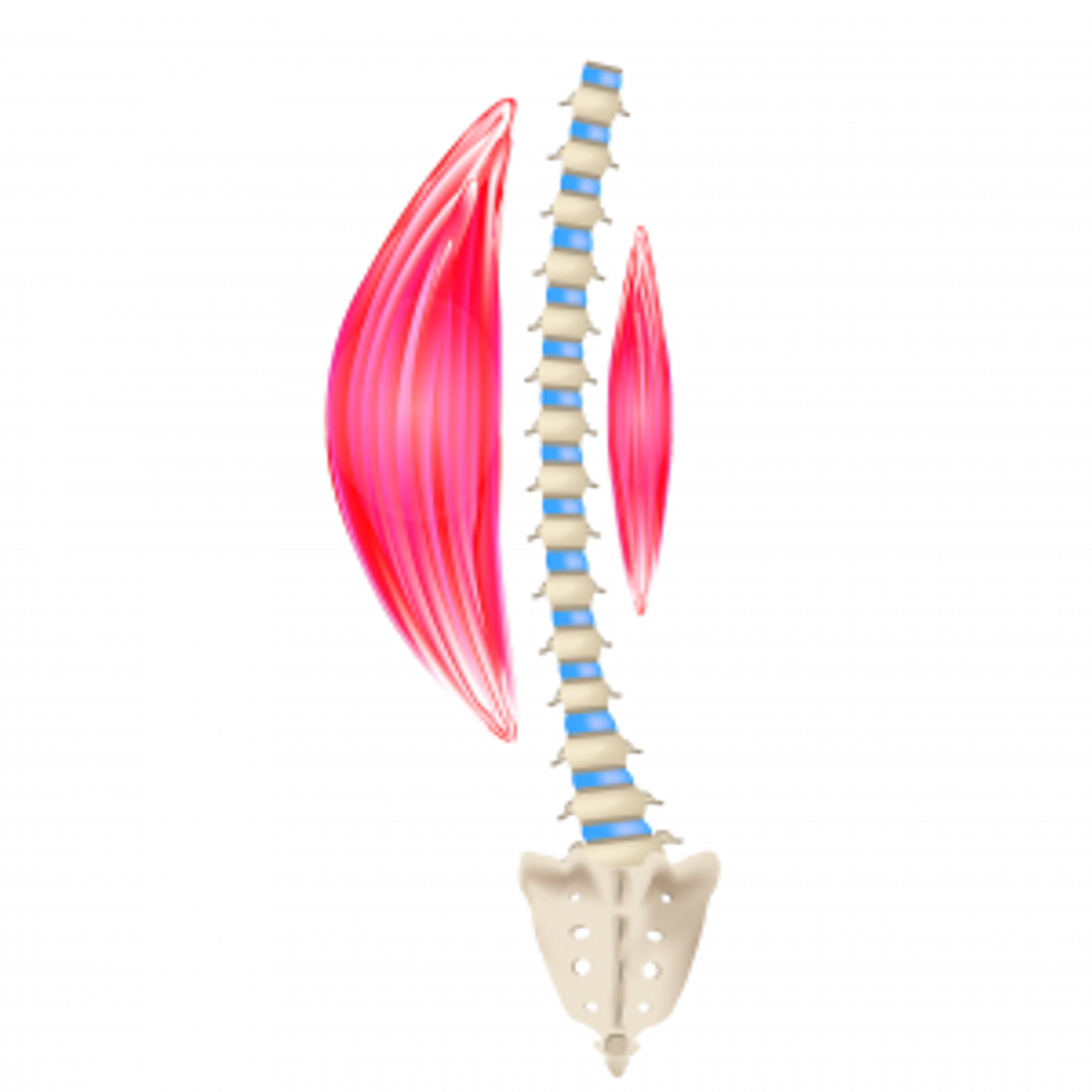 Illustration of a spine curving sideways with a larger back muscle on one side and a smaller one on the other