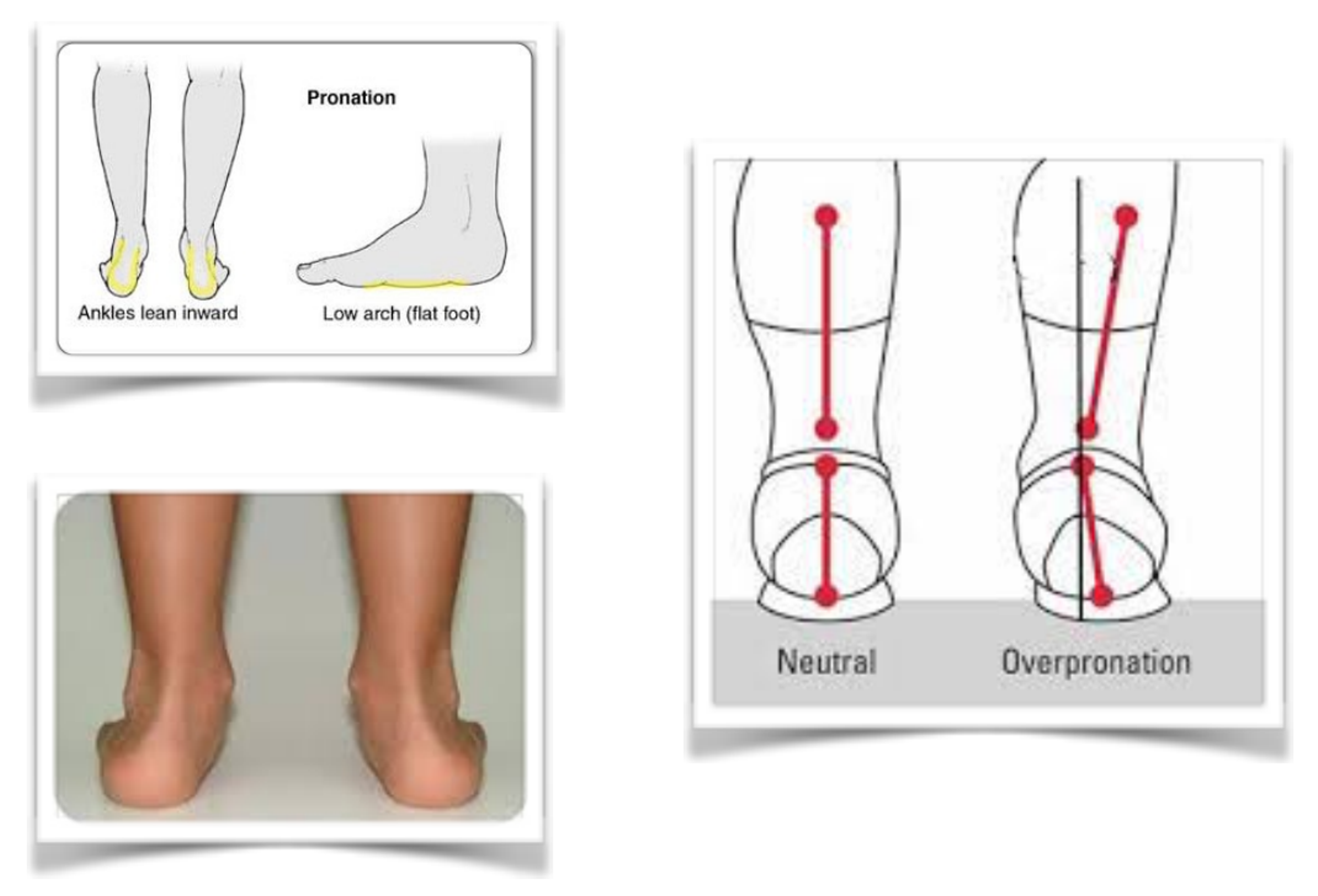 foot pronation