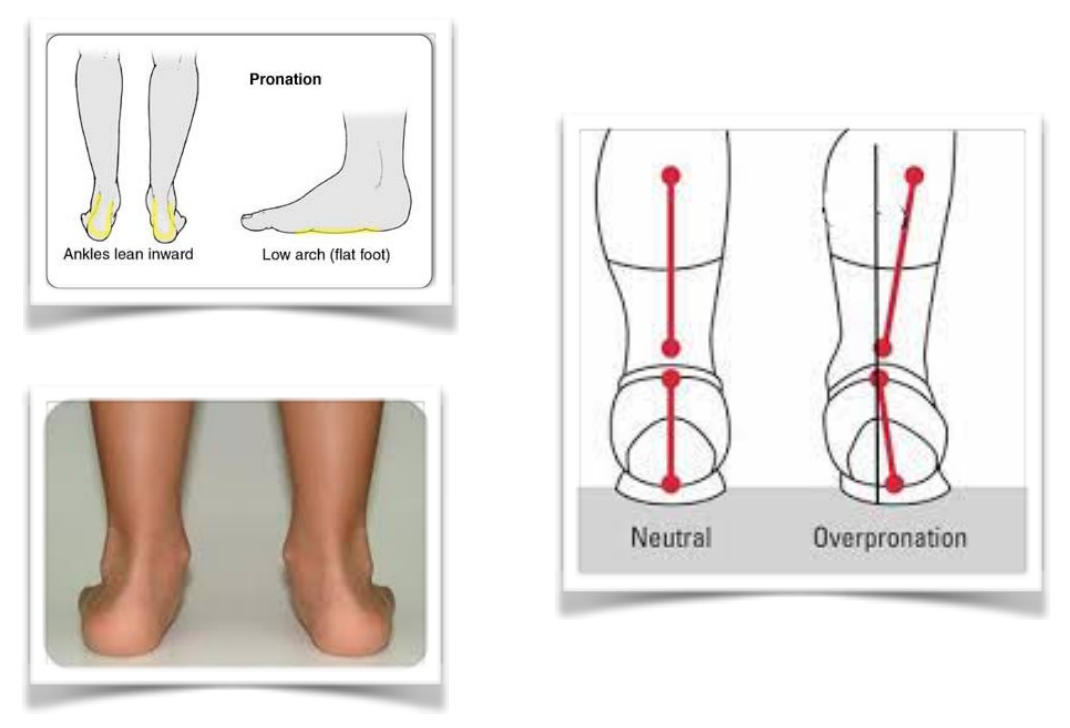 foot pronation