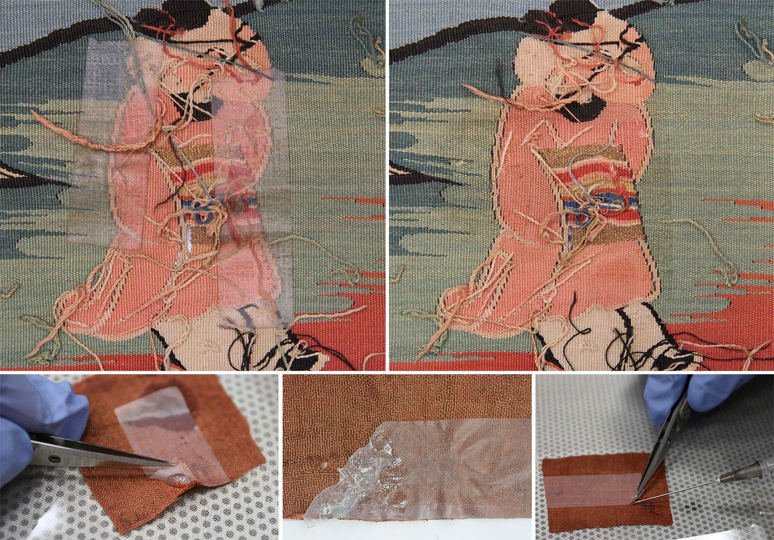 A boy with sticky tape on him; the sticky tape removed; photos of removing the tape with a tweezers and syringe