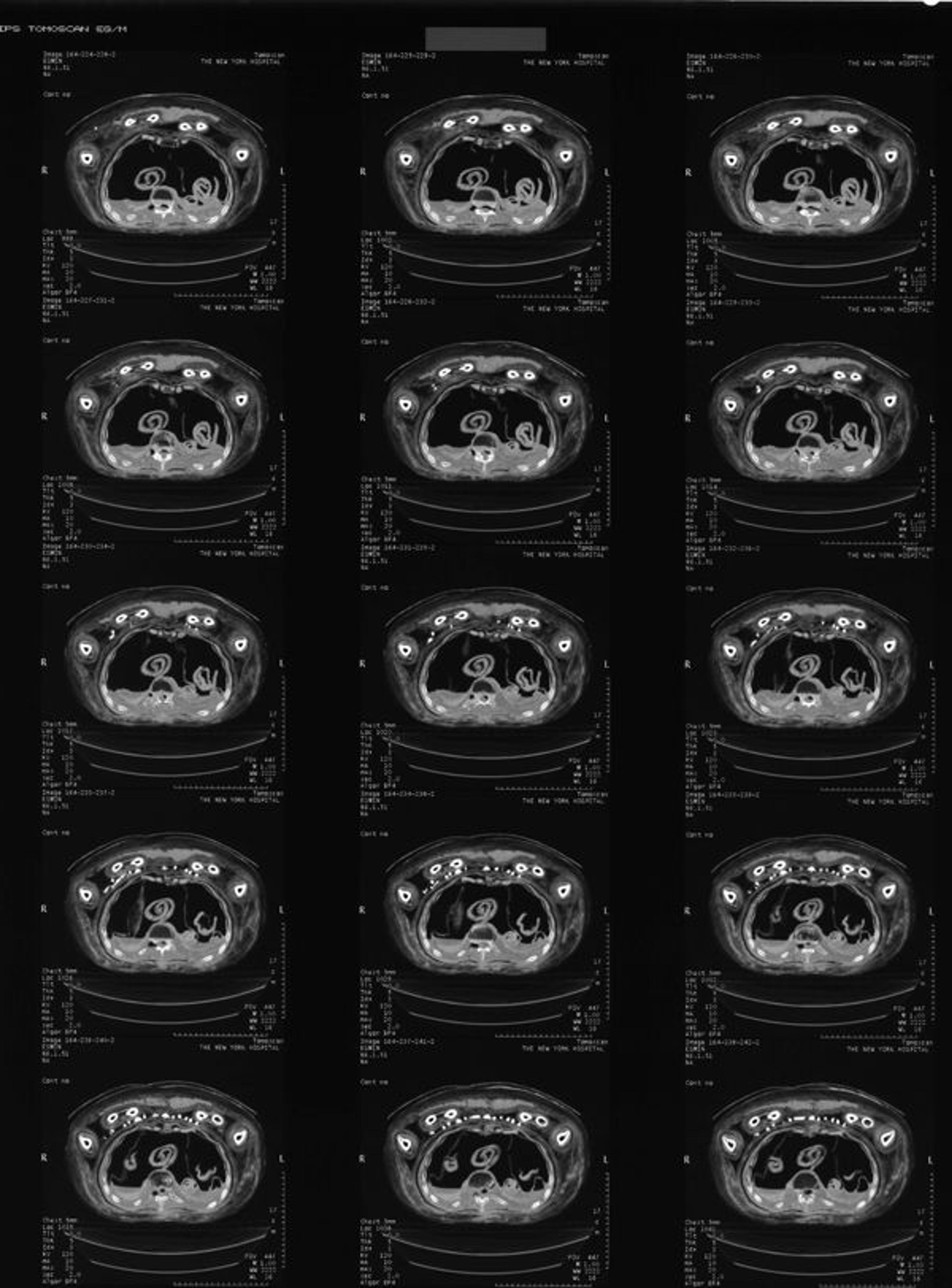Example of old film sheet with CT scan images of Nesmin from 1997
