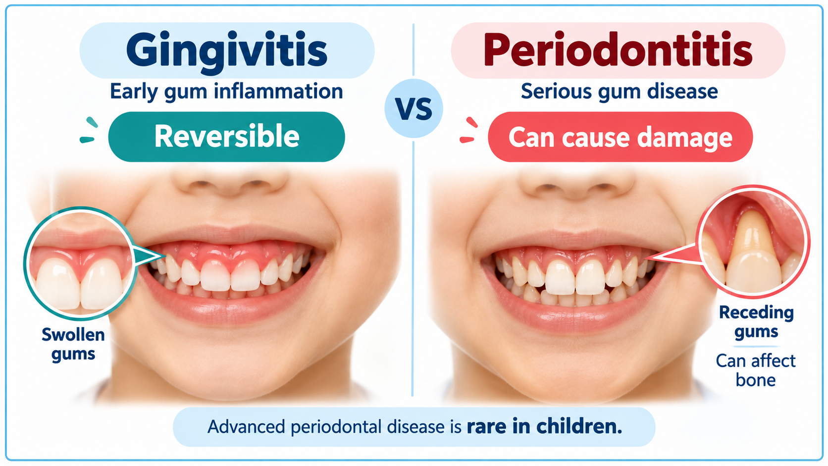 Gingivitis vs. Periodontitis