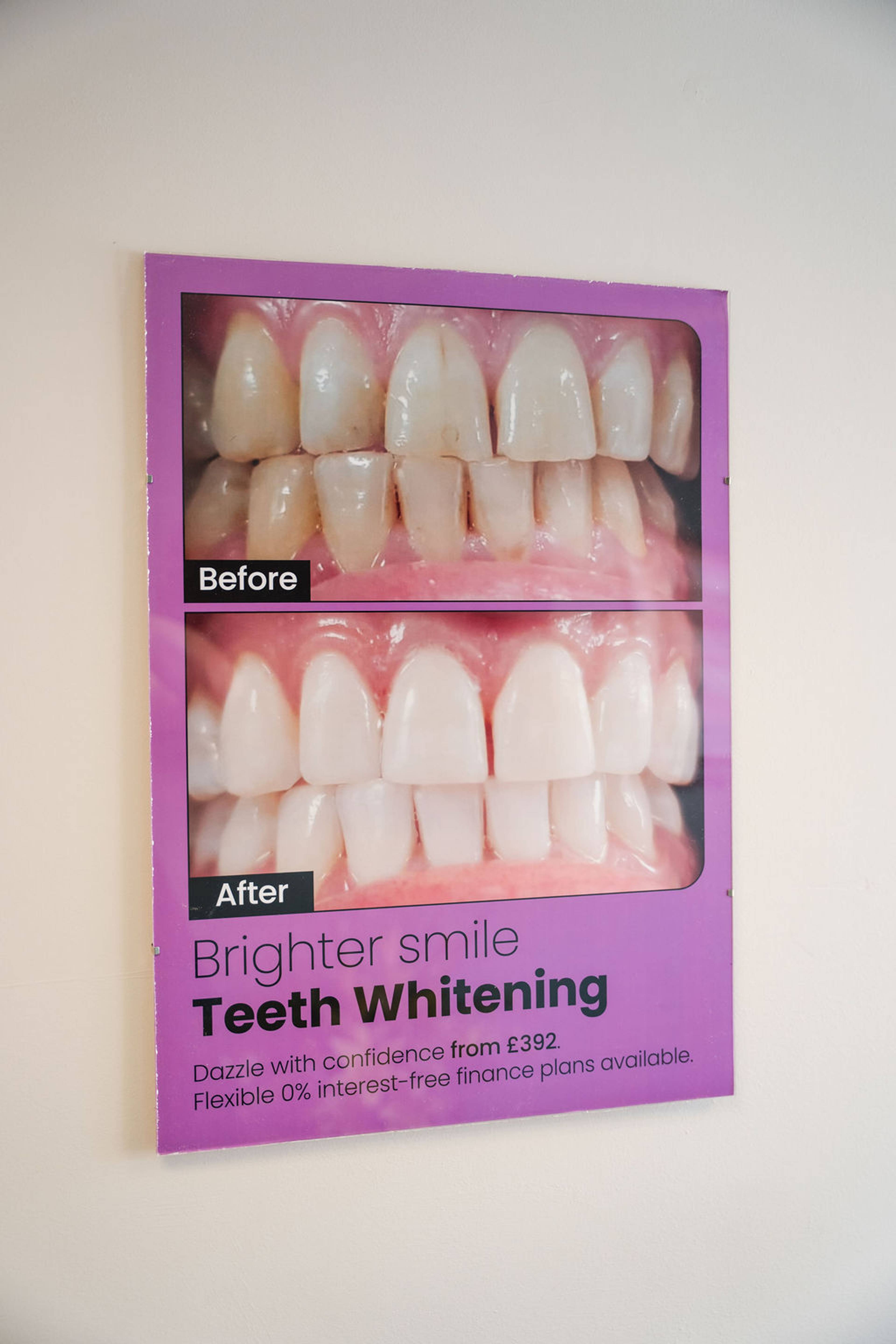 Before-and-after teeth whitening poster showing a comparison of tooth colour and smile brightness following cosmetic treatment.