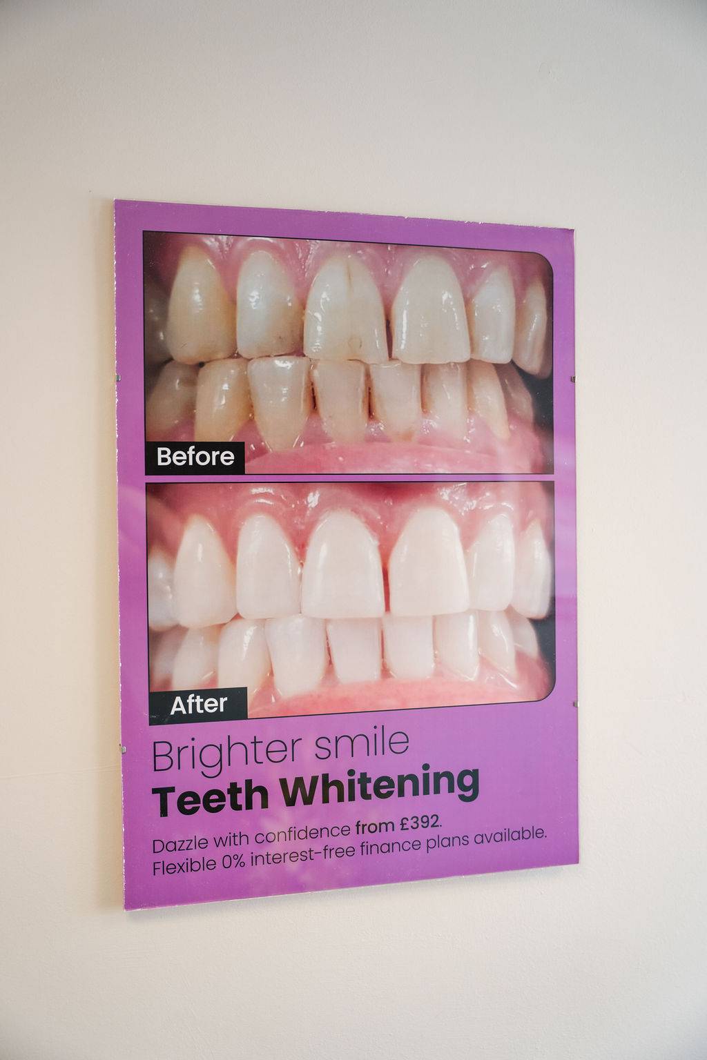 Before-and-after teeth whitening poster showing a comparison of tooth colour and smile brightness following cosmetic treatment.
