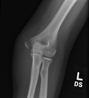 Displaced Condyle Fracture