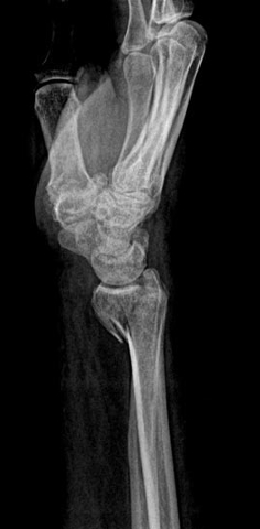 Unstable Volar Shear Fracture of Distal Radius