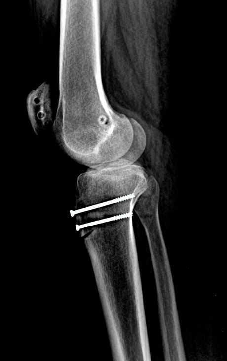 MPFL Reconstruction with Tibial Tubercle Osteotomy 2