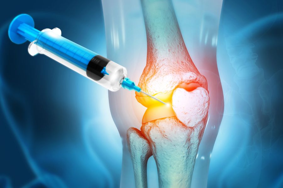 Illustration of a knee joint injection targeting damaged cartilage, highlighting orthobiologics treatments provided by the best orthopedic surgeon in San Francisco for joint pain and arthritis relief.