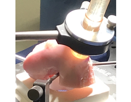 Allograft Plug Harvesting