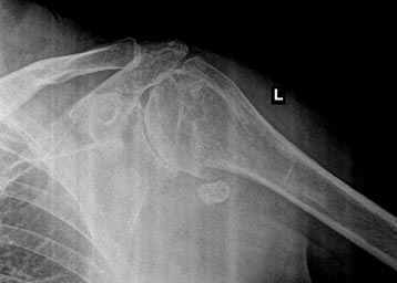 Bone of Bone Osteoarthritis of the Shoulder