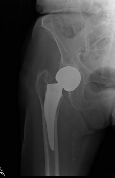 Partial Hip Replacement (Hemi-Arthroplasty)