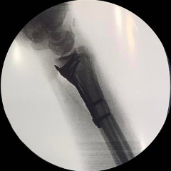 Repair of Distal Radius Fracture With Plate and Screws