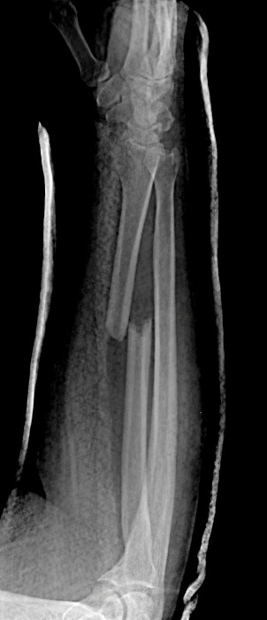 Radial Shaft Fracture