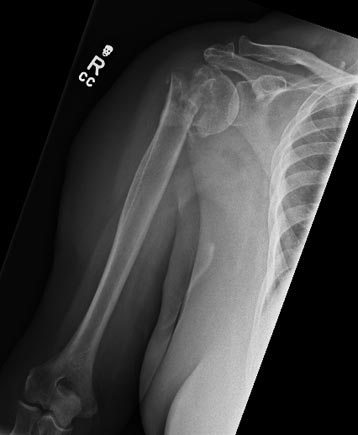Non-united Fracture of Proximal Humerus