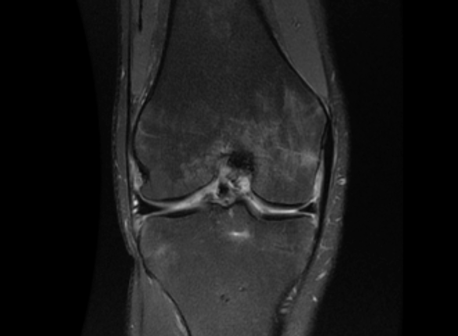 Post-operative MRI Showing Anatomic Healed Avulsion Fracture in Coronal View