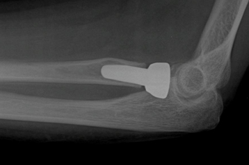 Post-Surgery